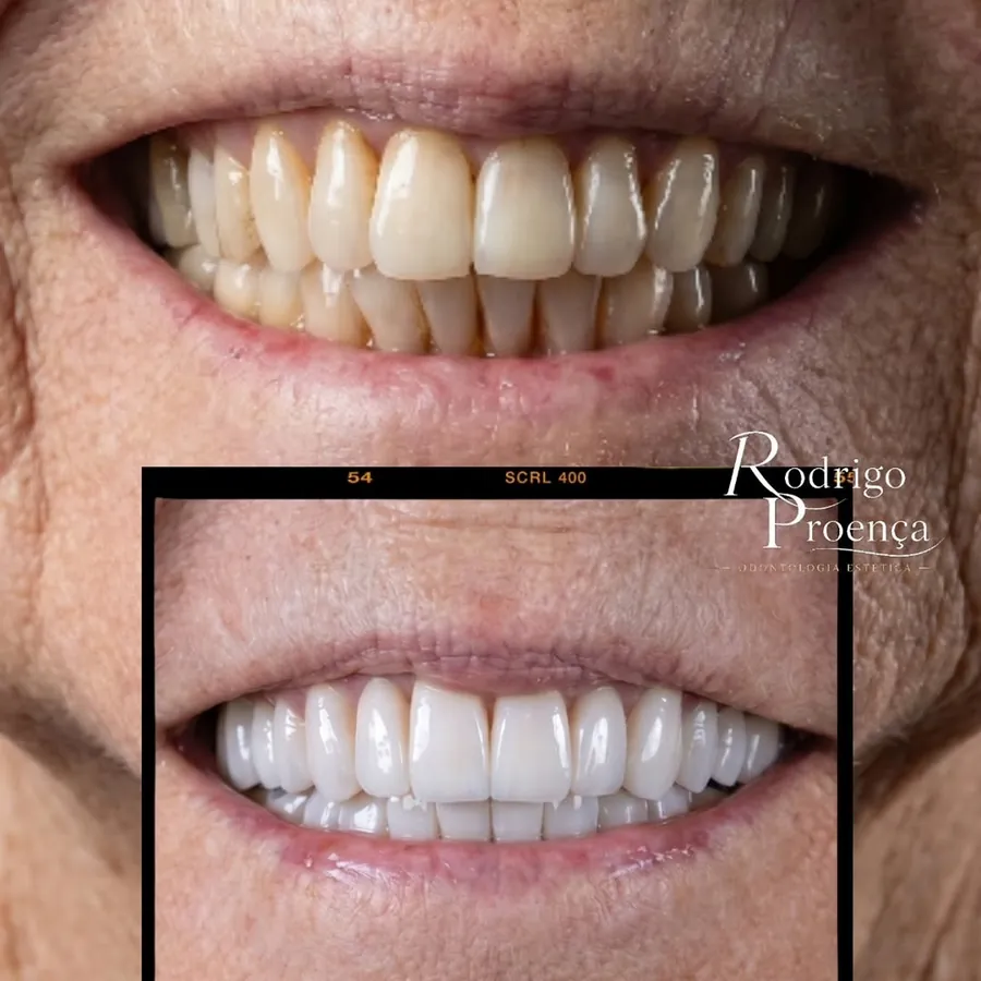 Antes e depois de reabilitação com 22 porcelanas em paciente de 71 anos
