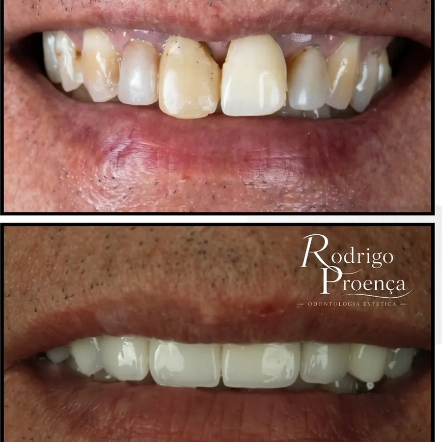 Antes e depois de reabilitação funcional e estética complexa