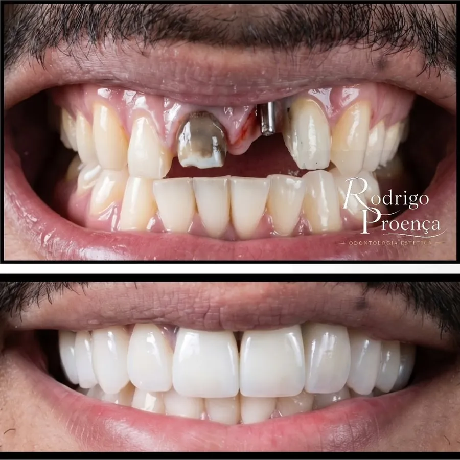 Antes e depois de reabilitação com lentes, coroas e implante