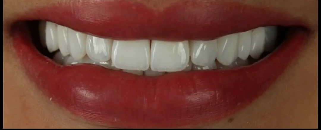 Sorriso com lentes de contato em porcelana, usado para mostrar as linhas de planejamento
